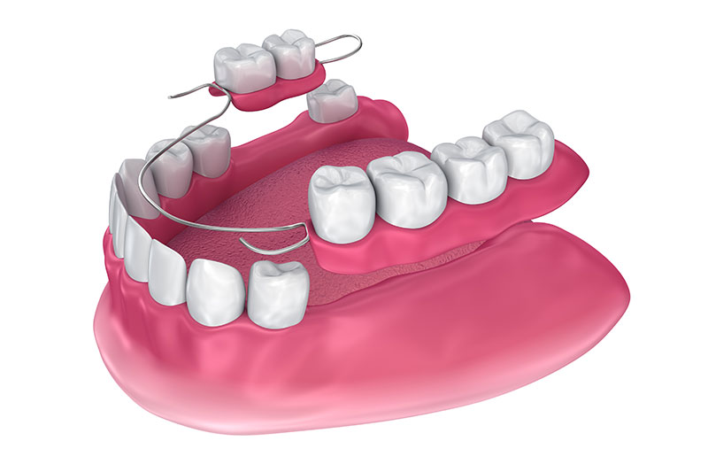 Partial Dentures in Newton Falls