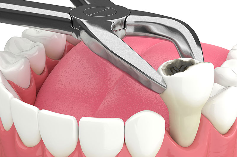Tooth Extraction in Newton Falls